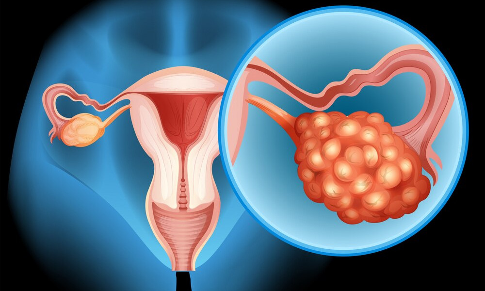 Different types of PCOS